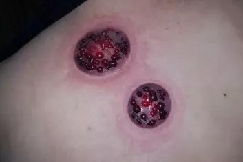 邓莎被烧伤原因,邓莎拔火罐被烧伤视频