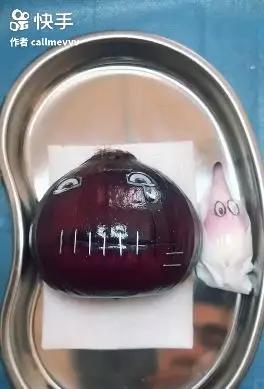 我在快手上看人切洋葱，竟然弄懂了剖腹产？