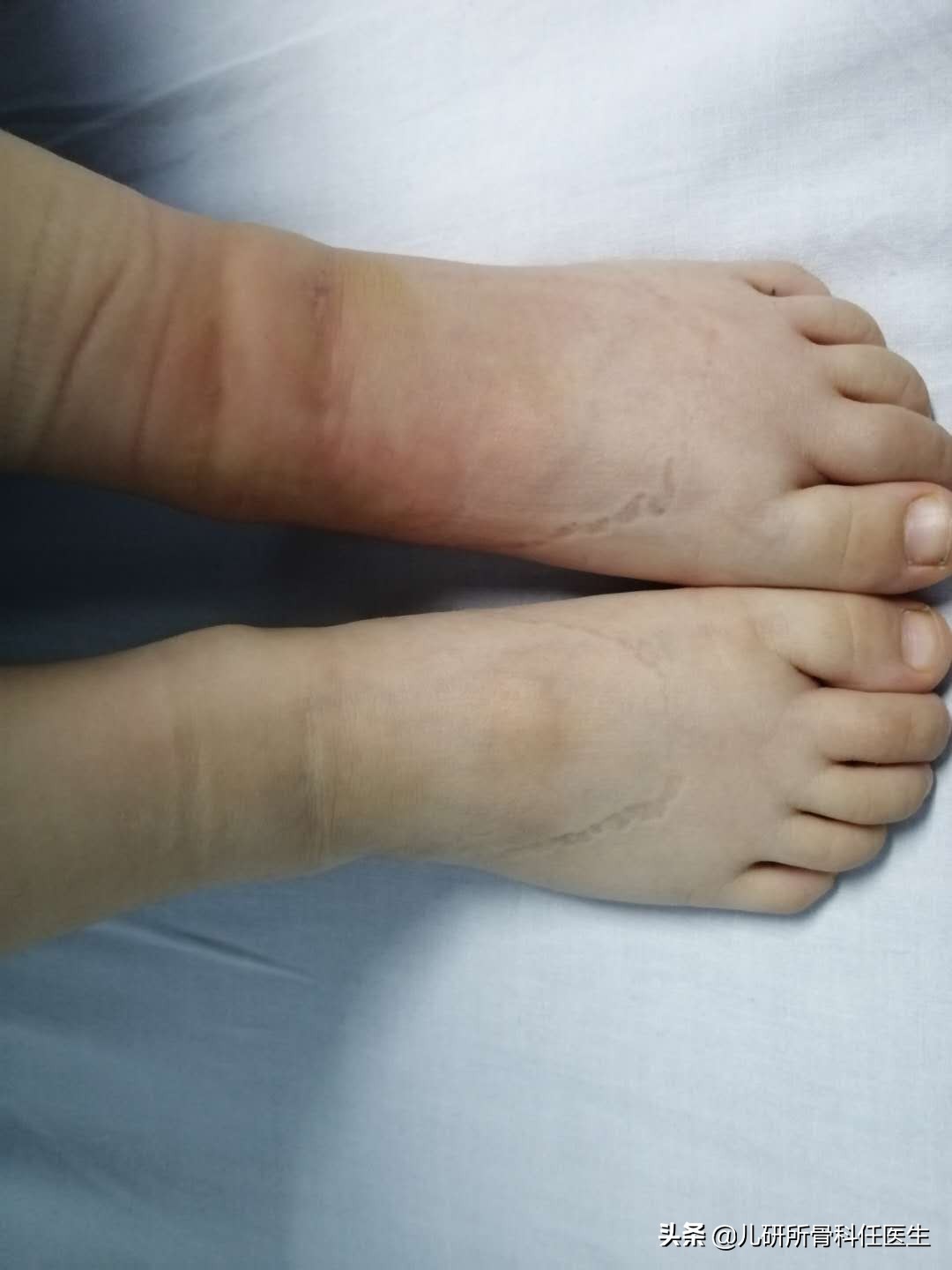 宝宝被蚊虫叮咬的正确处理方法,宝宝被蚊虫叮咬后如何正确处理