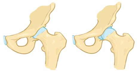 髋关节发育不良的正确诊断与治疗,髋关节发育不良和正常的区别