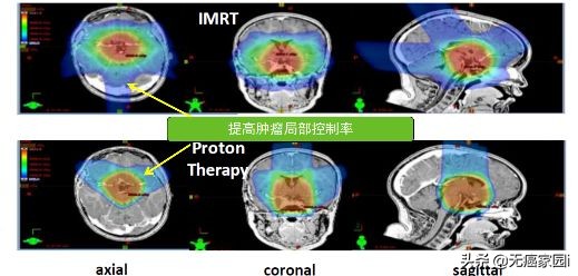 质子治疗手术适合大型肿瘤,肿瘤不能根治吗