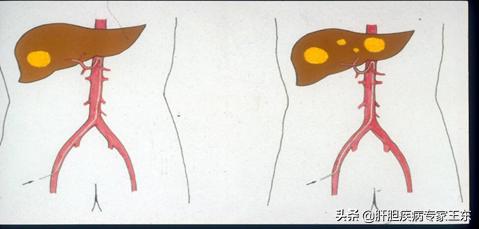 解读最新版肝癌诊疗规范,治疗肝癌恶性肿瘤的中药有哪些