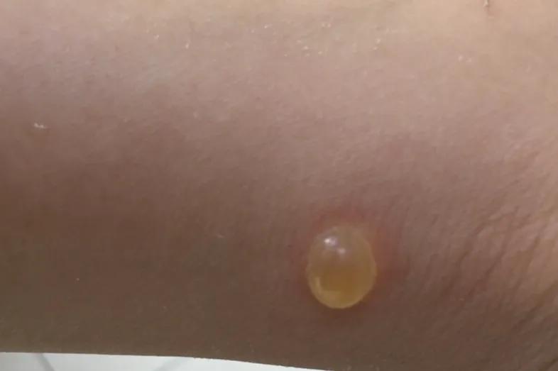 轻松应对夏季常见皮肤病（二）——虫咬皮炎！