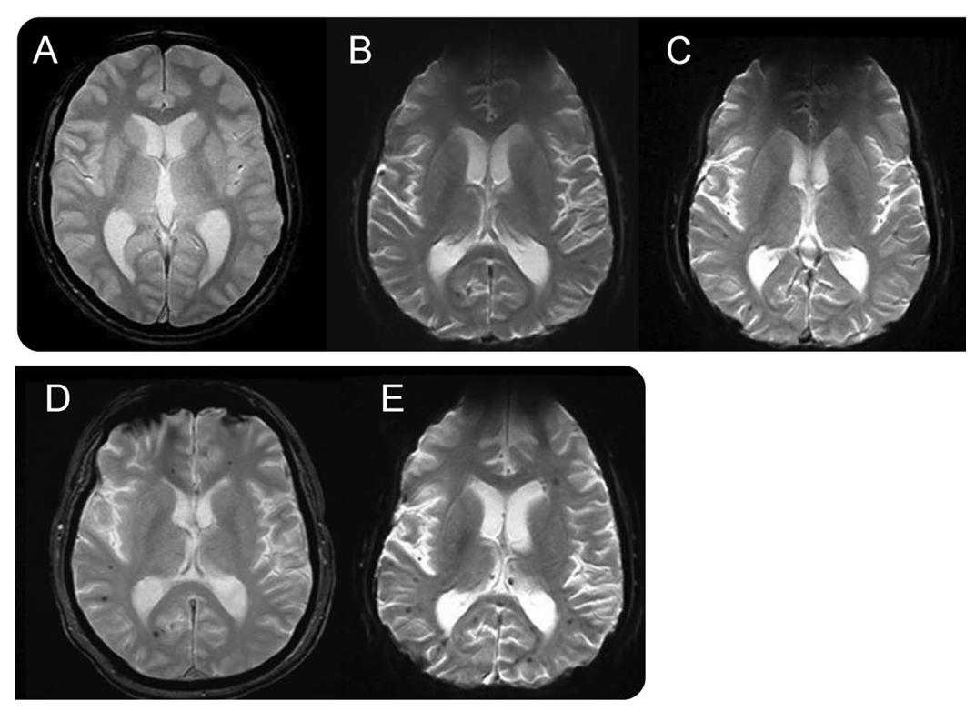 头疼做磁共振脑小血管有点出血,核磁共振说脑血管出血