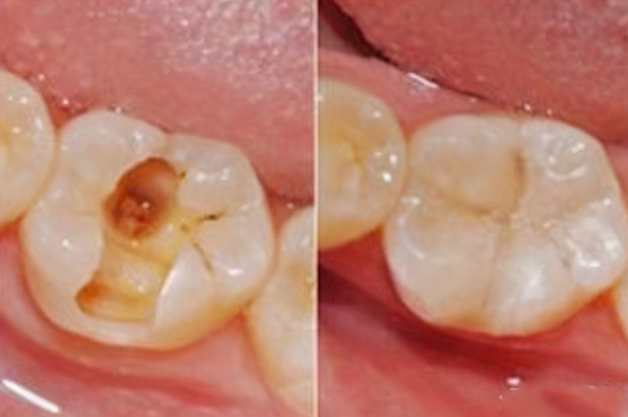 补完牙以后有什么注意事项,补完牙了要注意什么