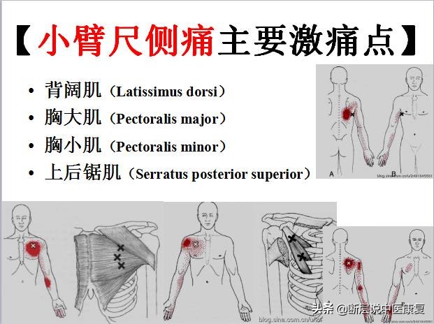 激痛点挂图,激痛点疗法笔记