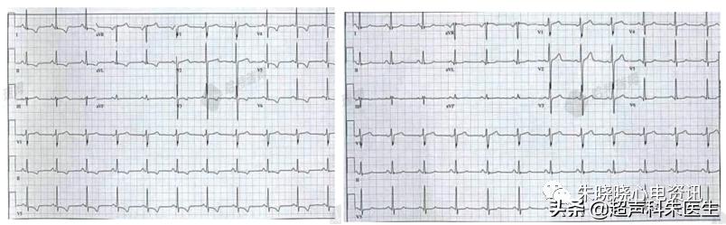 t波倒置诊断,t波倒置如何区分严重程度
