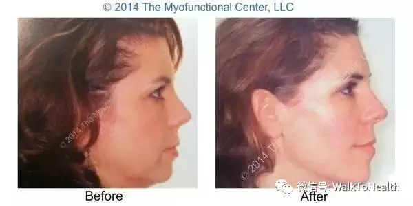 别让口呼吸毁掉你的颜值,脸毁了怎么补救