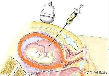 做羊水筛查容易导致流产吗,羊水穿刺检查有没有危险