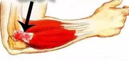 胳膊肘疼俗称网球肘怎么止痛,胳膊肘筋疼不敢伸直挂什么科