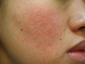 毛孔粗大显老,毛孔粗大显老焦虑