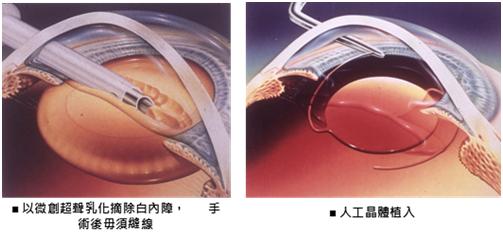 了解白内障的发病率,你了解先天性白内障吗