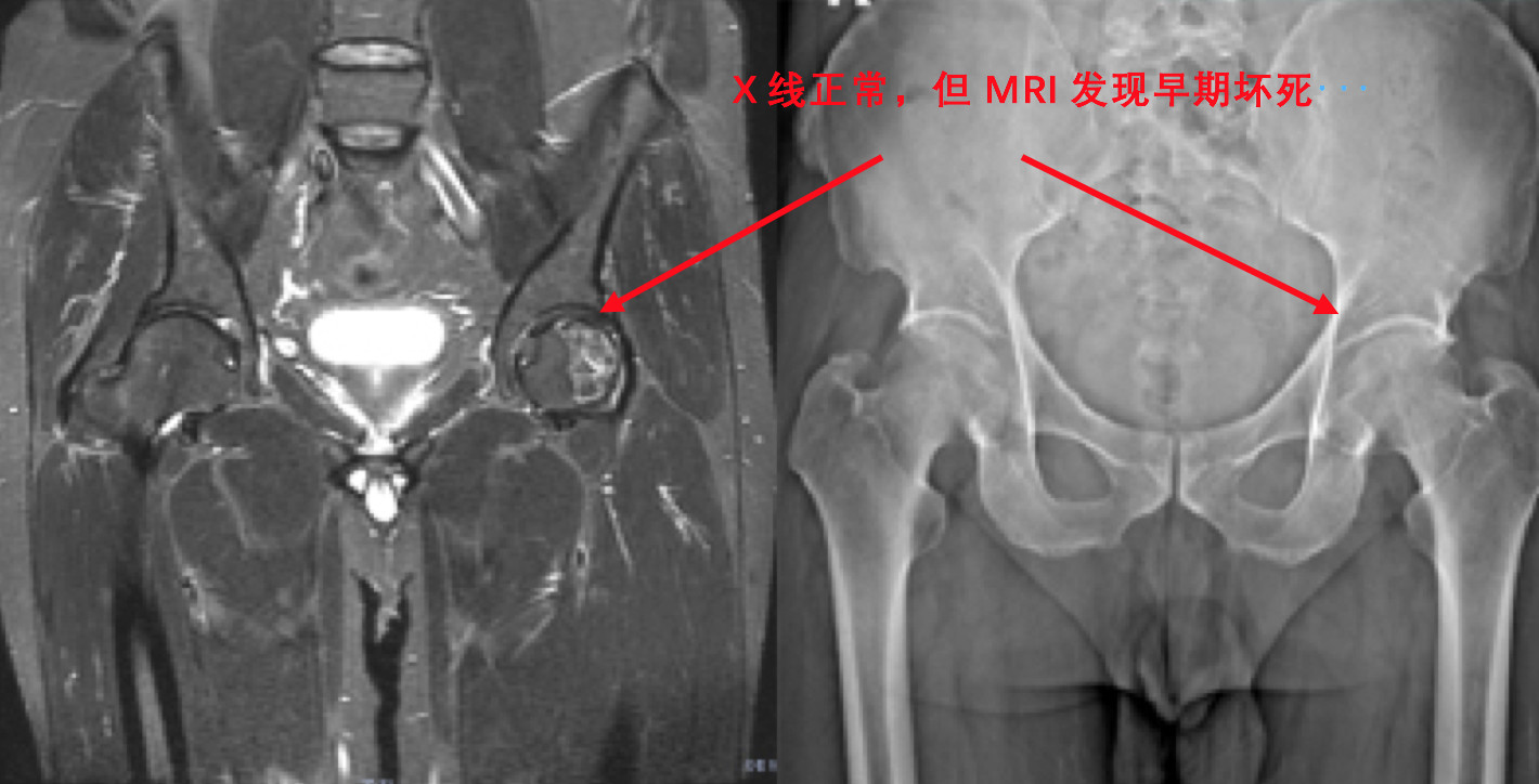 得了股骨头坏死又没钱治怎么办,股骨头坏死无药可治