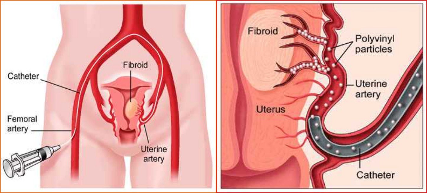 子宫肌瘤不能开刀只能化疗严重吗,子宫肌瘤介入栓塞治疗后注意事项
