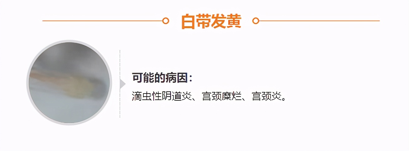 白带变黄或豆腐渣？这几种情况反映身体是否健康