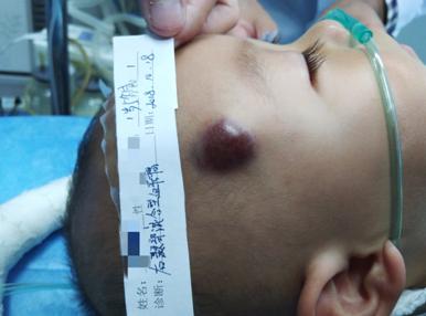 混合型血管瘤的治疗办法,混合型血管瘤的最佳治疗方法