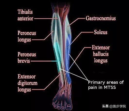 伤害了1/3跑者的胫骨炎,请务必重视起来