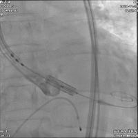 微创人工主动脉瓣膜置换术,微创介入主动脉瓣膜置换术