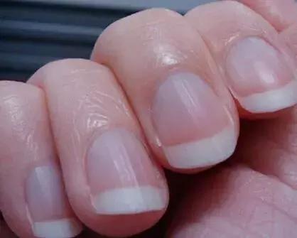 十岁孩子指甲上有竖纹是怎么回事,大拇指甲上有白色竖纹是怎么回事