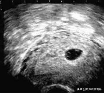 3毫米卵黄囊未见胎芽正常么,40多天的卵黄囊