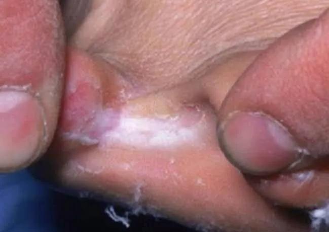 冬天治疗脚气的最快的5种方法,冀连梅抗生素