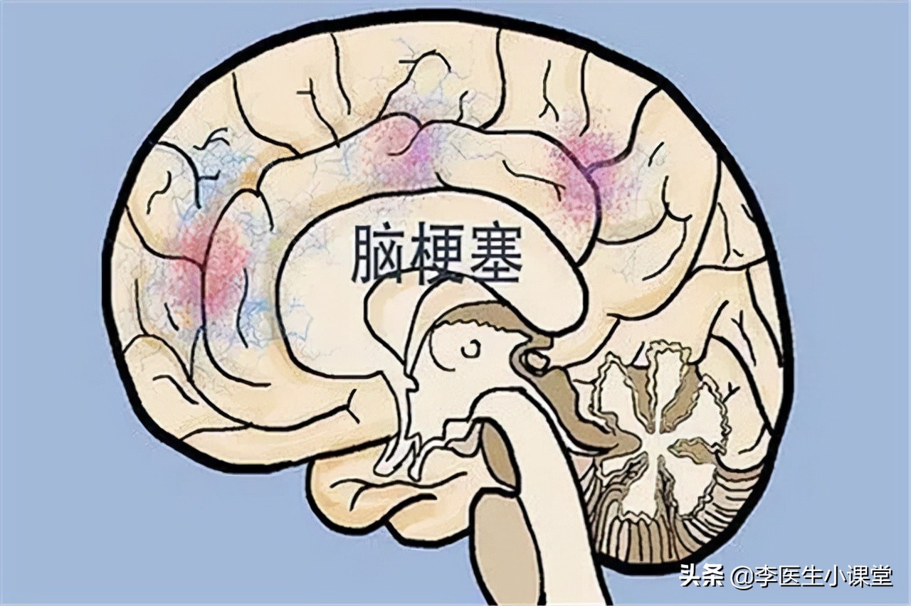 老年人补充叶酸预防脑梗有讲究,老人吃叶酸防脑梗有讲究