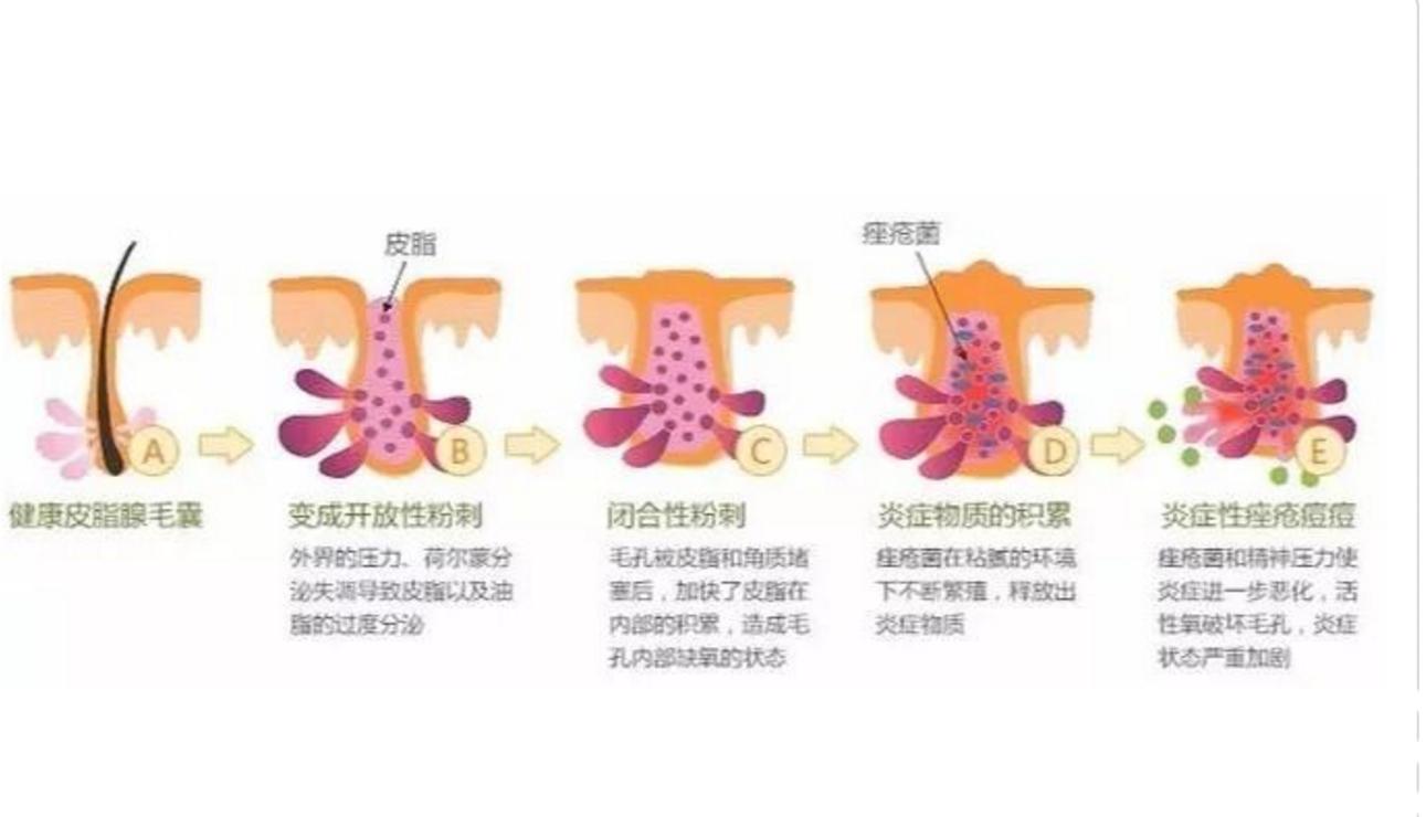 额头闭口反反复复怎么办,额头反反复复长闭口粉刺怎么办