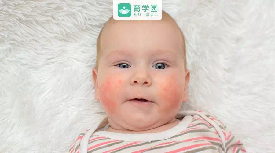 宝宝腹泻长湿疹是过敏吗,湿疹宝宝拉肚子吃什么奶粉