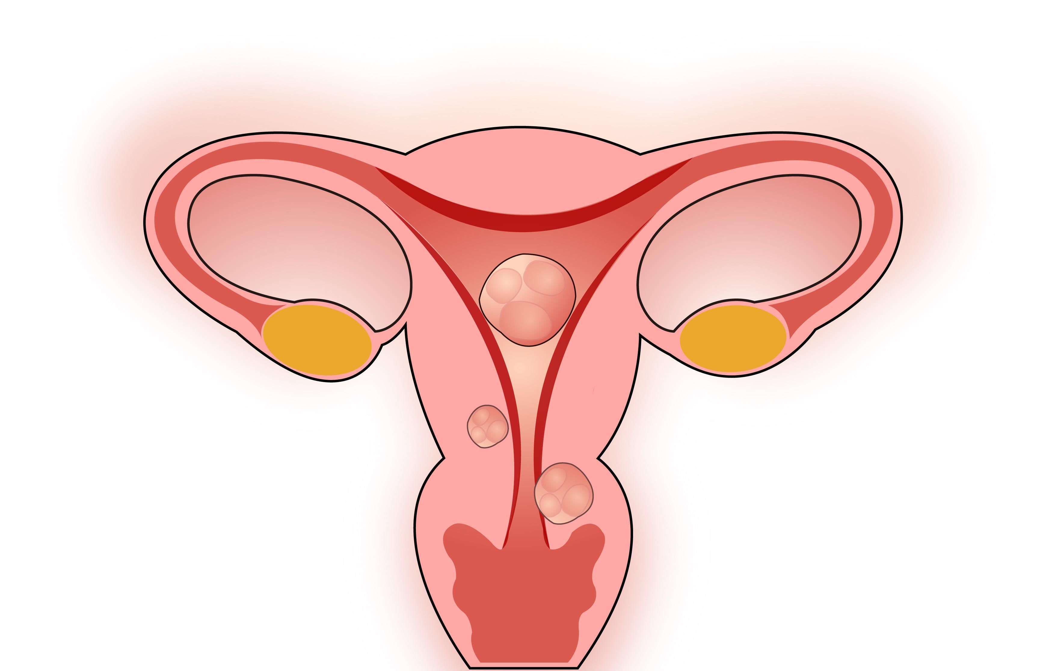 妇科恶性肿瘤严重吗,妇科哪些恶性肿瘤会有遗传性