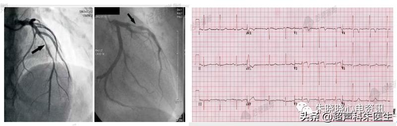 t波倒置诊断,t波倒置如何区分严重程度