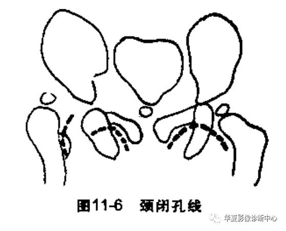 先天性髋关节脱位,先天性髋关节脱位属不属于残疾人