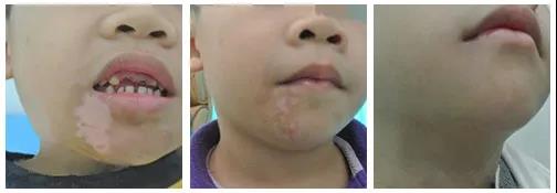 白癜风prp疗法多长时间一个疗程,白癜风光疗一个疗程需要做多少次