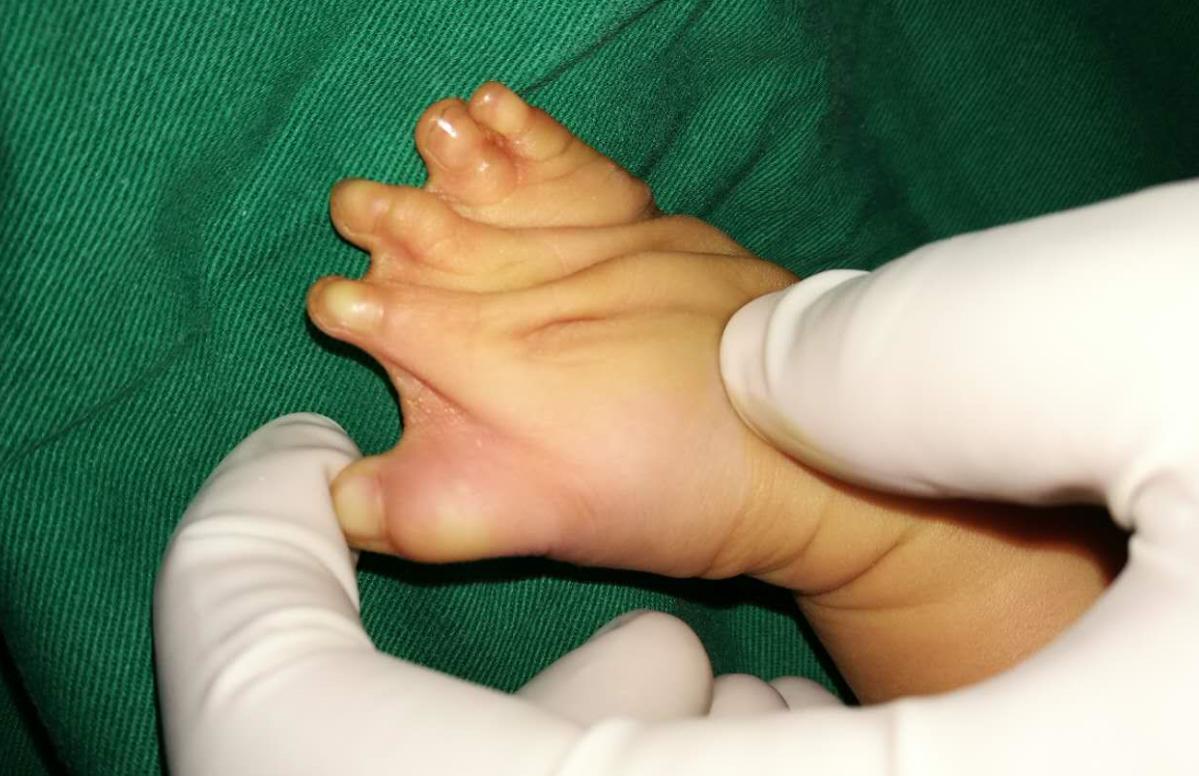 并指畸形免植皮案例,并指畸形