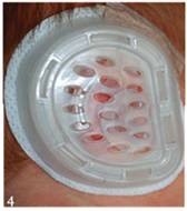 耳廓畸形高考生体检怎么办,二度耳廓畸形矫正方案