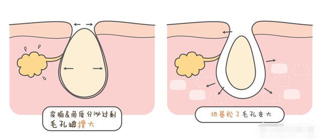 皮肤毛孔挤出黑的固体,皮肤干燥毛孔粗大该怎么解决