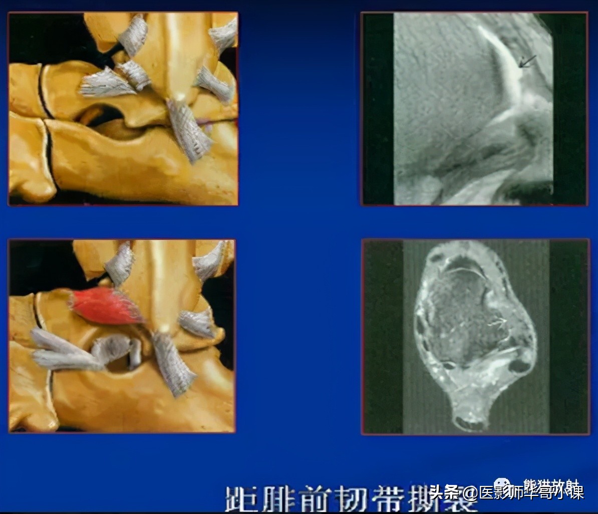 踝关节解剖视频课,解剖学韧带分布图