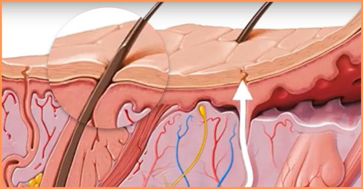 毛孔粗大怎么办方法其实很简单,毛孔粗大怎么办教你两招解决问题