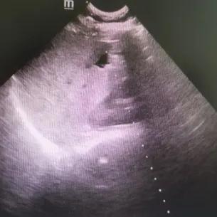 超声科治疗囊肿,肝囊肿超声引导下穿刺哪个医院好