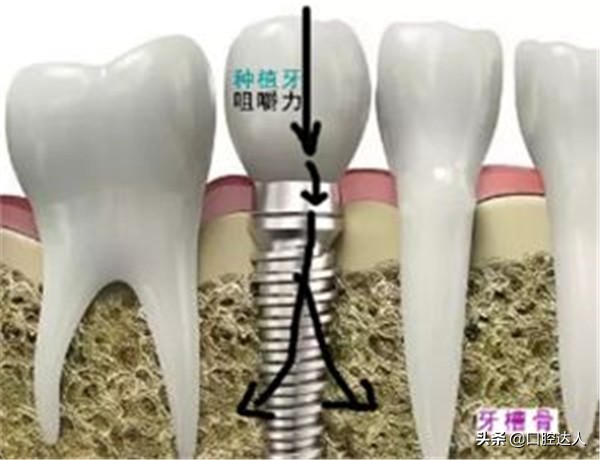 门牙掉了种植牙好还是烤瓷牙美观,门牙缺失两颗做烤瓷牙还是种植牙