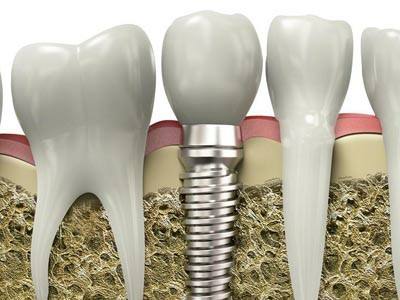 种植牙钛合金是金属吗,种植牙种植体对骨头好吗