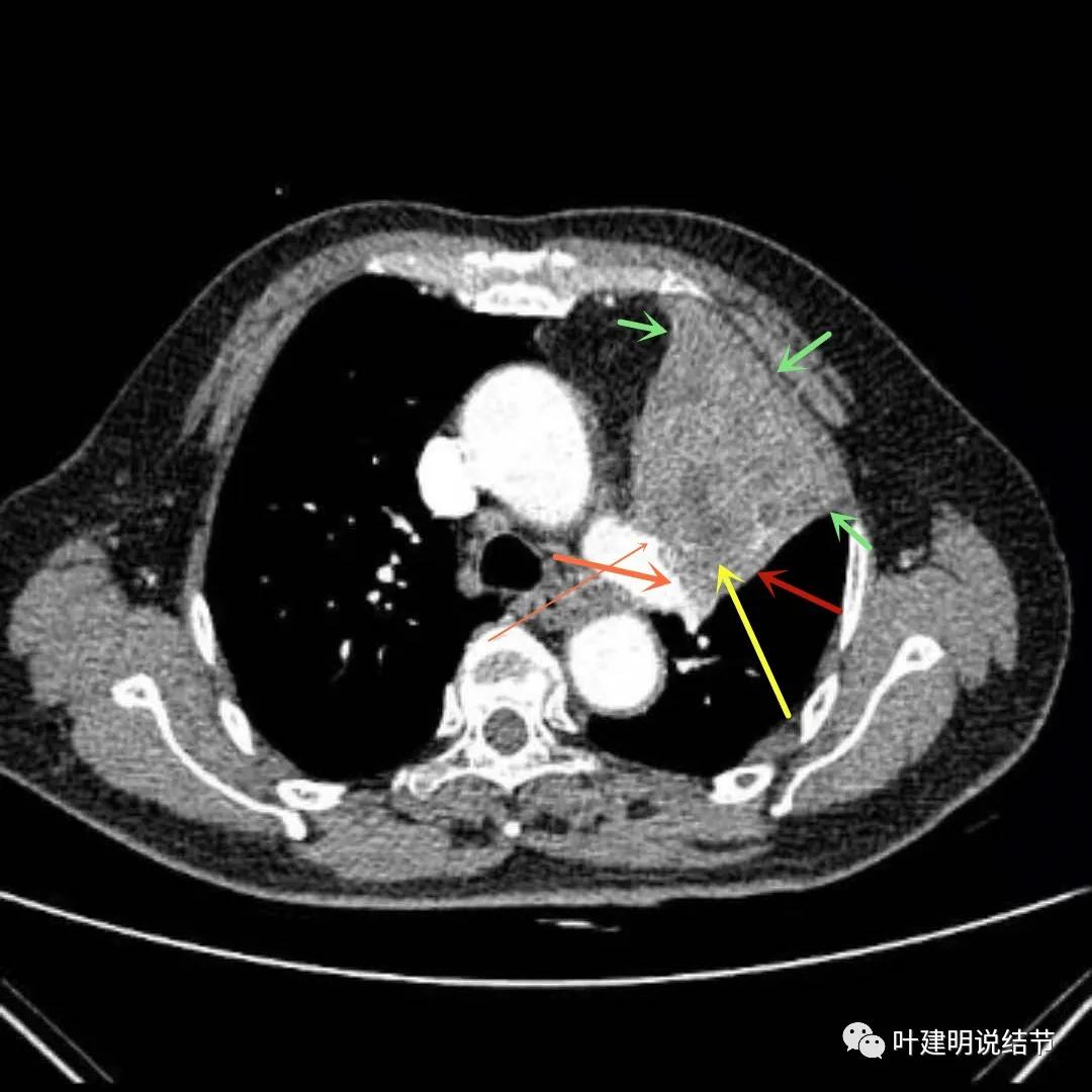 高龄肺癌靶向治疗效果,高龄老人肺癌早期适合放疗吗
