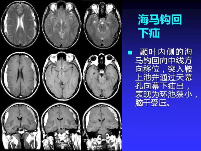 头颅mri读片视频教程,颅脑mri读片入门教程视频讲解全集