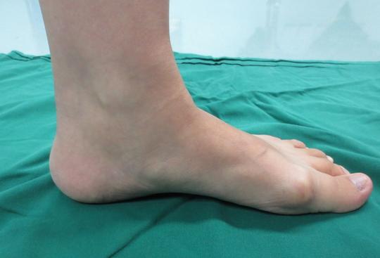 扁平足穿没有足底支撑的鞋,如何改善扁平足穿鞋的效果