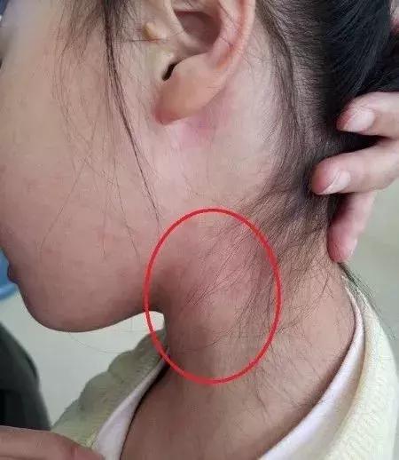 孩子扁桃体发炎连续三天高烧不退,老人连续几天高烧不退怀疑什么病