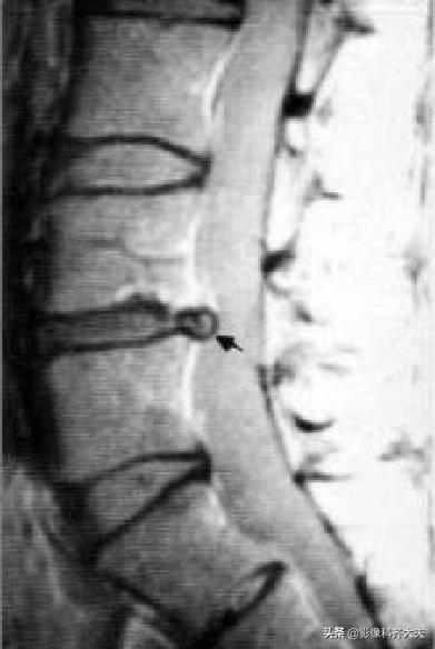 腰椎间盘突出最好的影像诊断方法,腰椎间盘突出的影像学检查