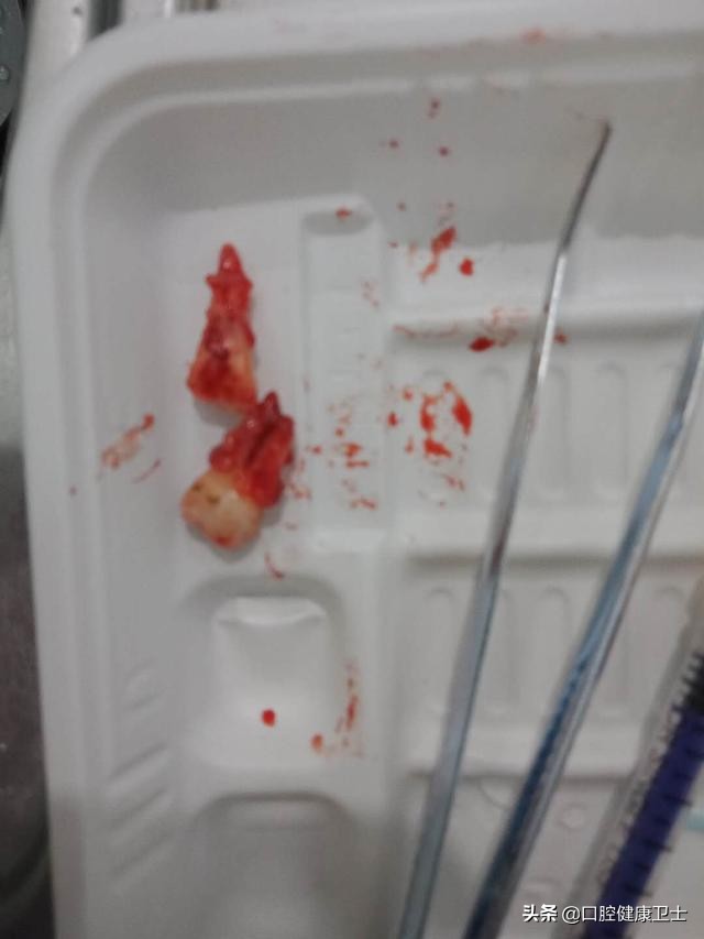 牙齿劈裂怎么处理,牙齿劈裂的补救方法