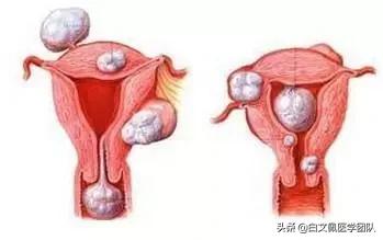 子宫肌瘤卵巢囊肿有什么偏方,卵巢囊肿子宫肌瘤同时存在很崩溃