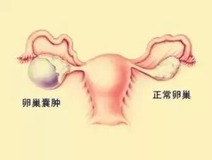 哪些妇科病影响备孕影响到生育,备孕期间有炎症会影响怀孕吗