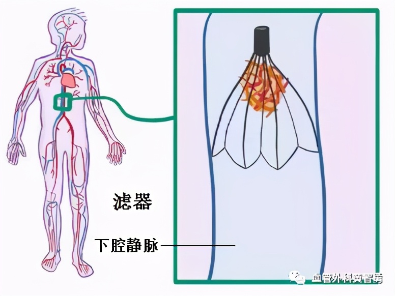 血栓状态保胎到什么时候安全,怀孕卧床保胎容易得下肢静脉血栓