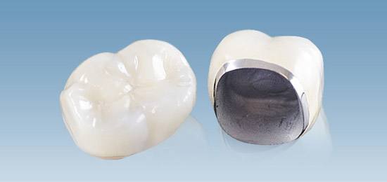 400块钱的烤瓷牙是什么种类,一般种500块钱的烤瓷牙靠谱吗